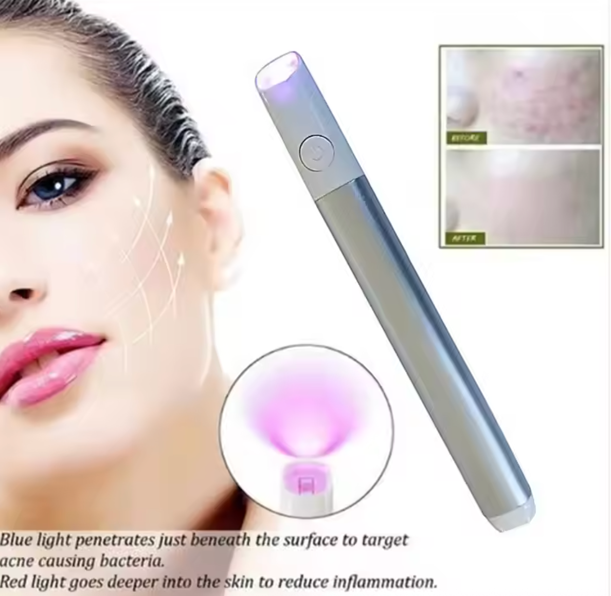 Red And Blue Light Therapy Acne Removal Laser Pen